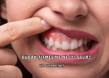 Dudak Şişmesine Ne İyi Gelir?