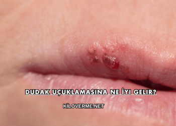 Dudak Uçuklamasına Ne İyi Gelir?