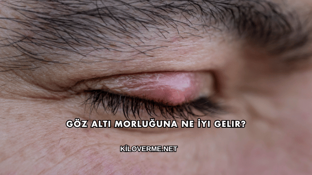 Göz Altı Morluğuna Ne İyi Gelir?