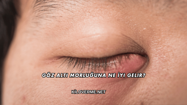 Göz Altı Morluğuna Ne İyi Gelir?