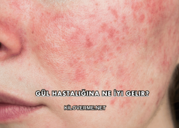 Gül Hastalığına Ne İyi Gelir?