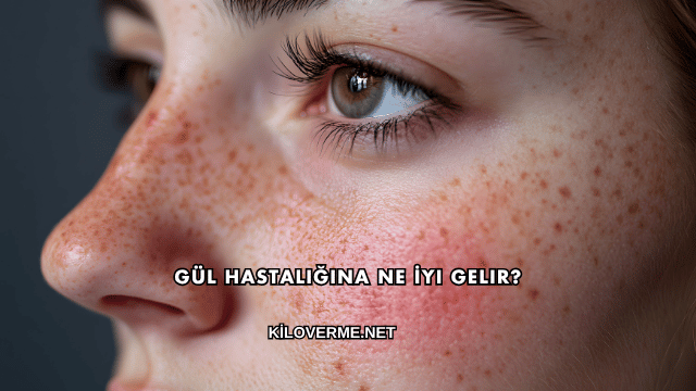 Gül Hastalığına Ne İyi Gelir?