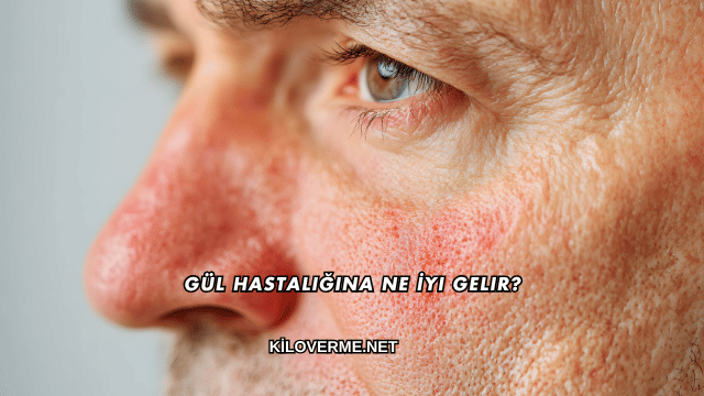 Gül Hastalığına Ne İyi Gelir?