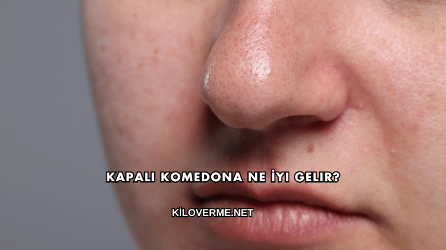 Kapalı Komedona Ne İyi Gelir?
