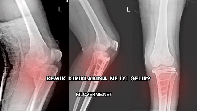 Kemik Kırıklarına Ne İyi Gelir?