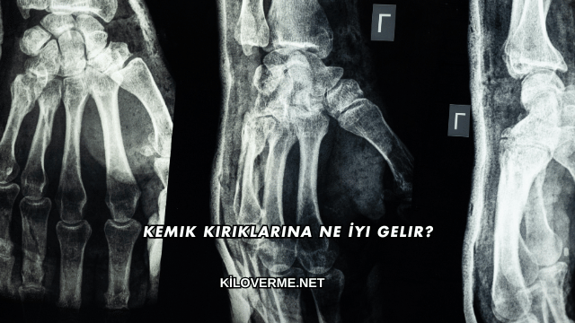 Kemik Kırıklarına Ne İyi Gelir?