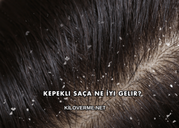 Kepekli Saça Ne İyi Gelir?