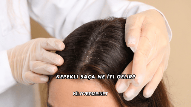 Kepekli Saça Ne İyi Gelir?