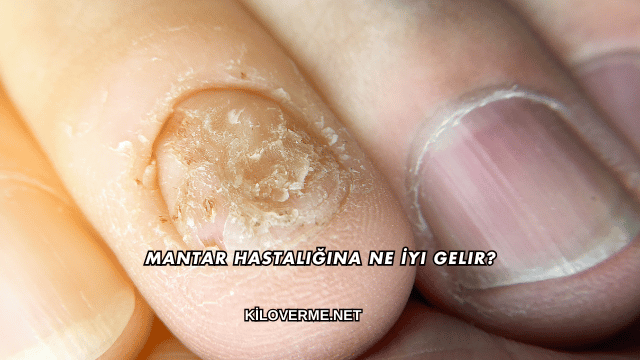 Mantar Hastalığına Ne İyi Gelir?