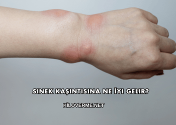 Sinek Kaşıntısına Ne İyi Gelir?