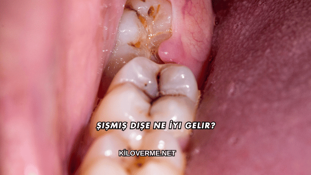 Şişmiş Dişe Ne İyi Gelir?