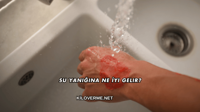 Su Yanığına Ne İyi Gelir?