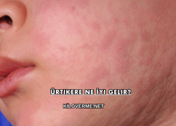 Ürtikere Ne İyi Gelir?