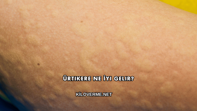 Ürtikere Ne İyi Gelir?