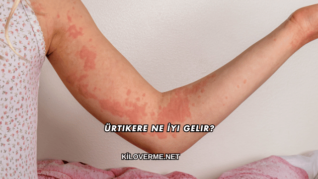 Ürtikere Ne İyi Gelir?