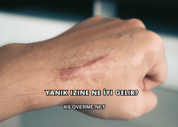 Yanık Izine Ne İyi Gelir?