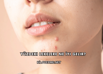 Yüzdeki Lekelere Ne İyi Gelir?