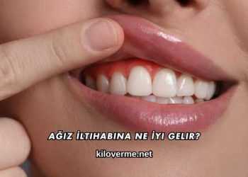 Ağız İltihabına Ne İyi Gelir?