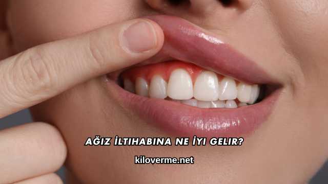 Ağız İltihabına Ne İyi Gelir?