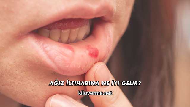 Ağız İltihabına Ne İyi Gelir?