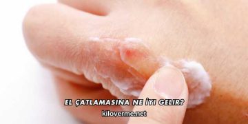 El Çatlamasına Ne İyi Gelir?
