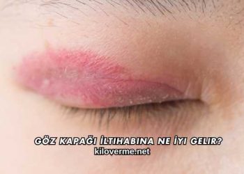 Göz Kapağı İltihabına Ne İyi Gelir?