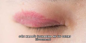 Göz Kapağı İltihabına Ne İyi Gelir?