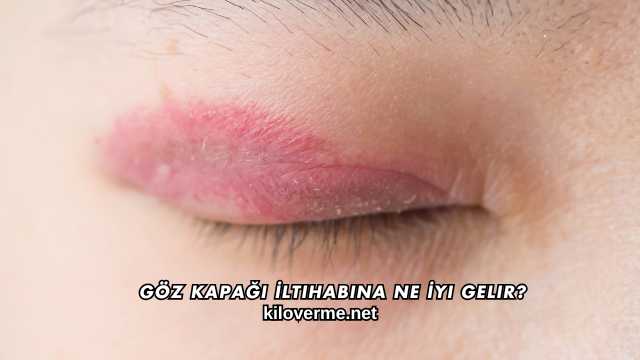 Göz Kapağı İltihabına Ne İyi Gelir?