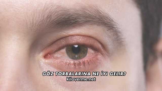 Göz Torbalarına Ne İyi Gelir?