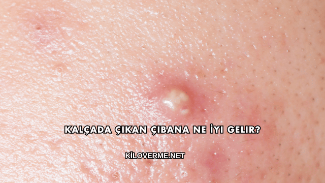 Kalçada Çıkan Çıbana Ne İyi Gelir?