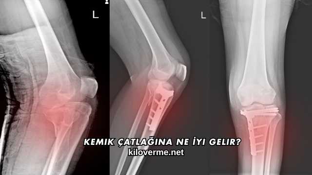 Kemik Çatlağına Ne İyi Gelir?