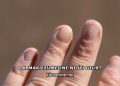 Parmak Ezilmesine Ne İyi Gelir?