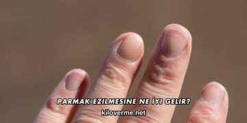Parmak Ezilmesine Ne İyi Gelir?