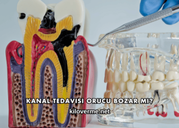 Kanal Tedavisi Orucu Bozar mı?